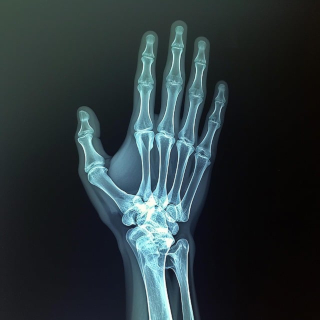 X-Ray of a Hand